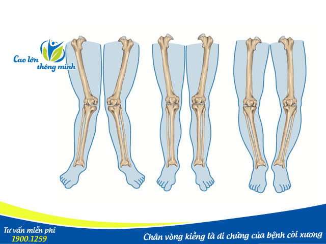 Bệnh còi xương nếu không điều trị kịp thời có thể khiến trẻ bị chân vòng kiềng