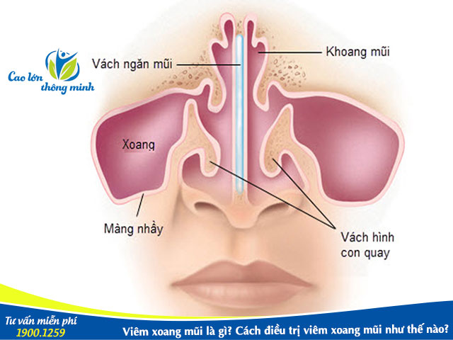 Bệnh viêm xoang mũi và cách điều trị